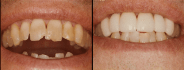 Porcelain Laminates to correct chipped and crooked teeth.