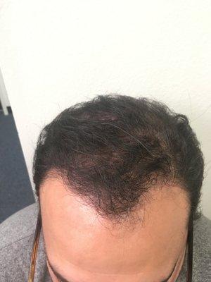 6 months after hair transplant