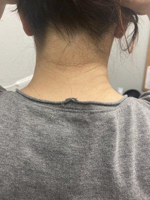 Back of the Neck; Skin Lightening Treatment before and after