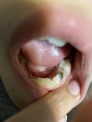 According Dr Ryan mcCormick and their office manager Mackenzie this silver filling in my son's mouth is white ‍