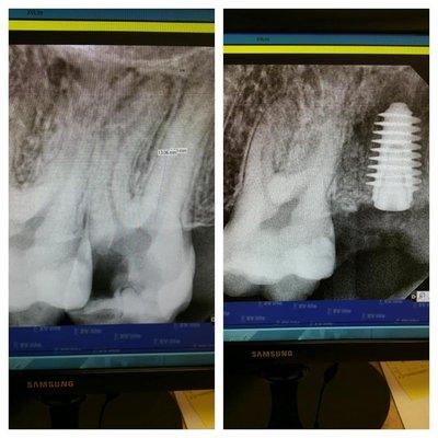 Immediate Implant #15