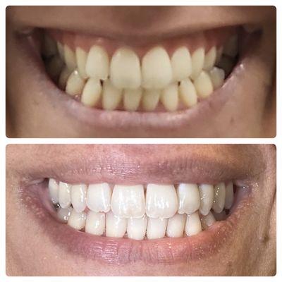 Invisalign and whitening