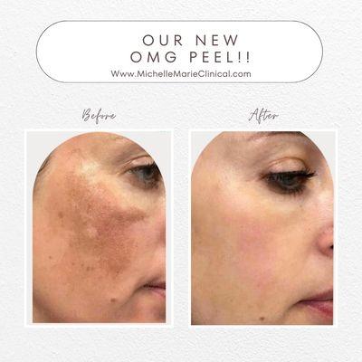 Book now for my customized OMG peel! By Biorepeel Series available for best results