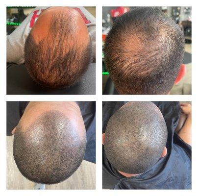 Balding or thinning? Ask about a permanent fix by SMP scalp micro pigmentation