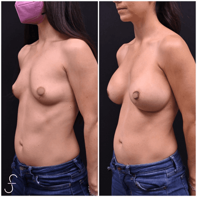 Breast Augmentation