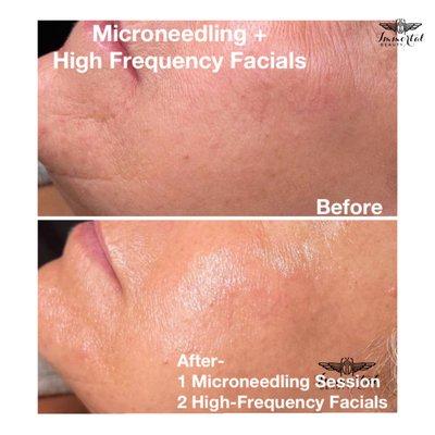 Microneedling-Collagen Induction Therapy + High Frequency Facials