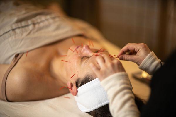 Cosmetic Acupuncture A holistic alternative to botox, this method awakens your skin's natural vitality, offering a youthful and radiant glow