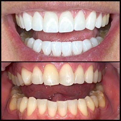 Veneers and crowns