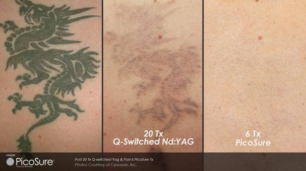 PicoSure Laser Tattoo Removal