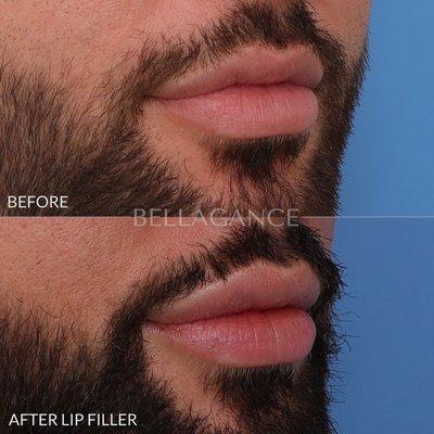 Lip filler treatment to add hydration, slightly plump the lip, and improve lip contour.