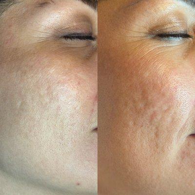 Acne scar treatment with PRP