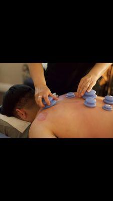 Cupping therapy