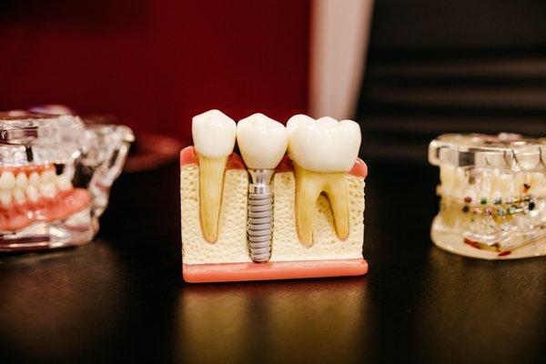 Implants and implant crowns