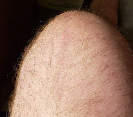 Scar from Knee Replacement Surgery