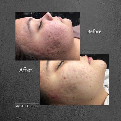 Microneedling