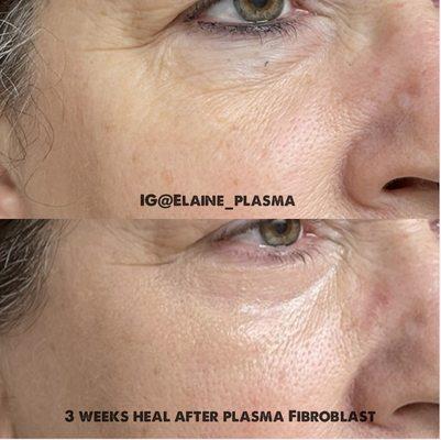 Non surgical results in lower eyelid with newest technology plasma pen fibroblast