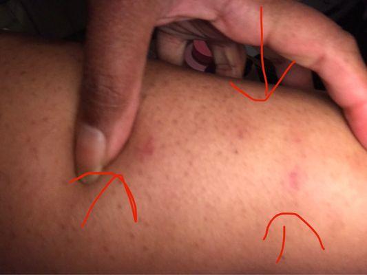 Bed bug bites