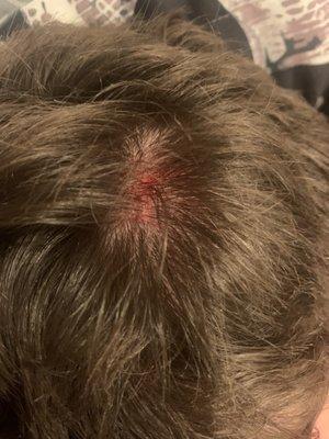 My injury to the back left side of my head.