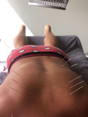 Acupuncture balance treatment