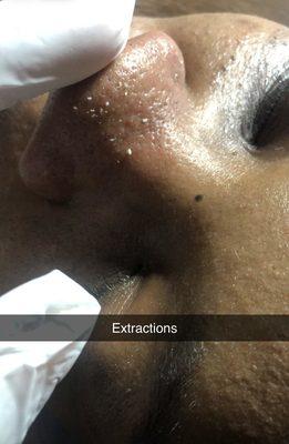 Extractions on the nose