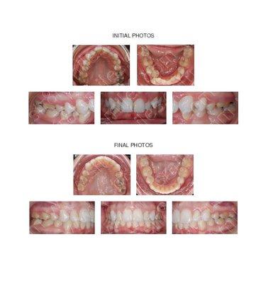 Adult with severe crowding and very deep bite treated with conventional braces and four bicuspid extractions.