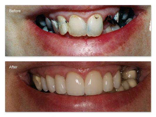 Dr. Hosner removed all the decay and restored with porcelain crowns.