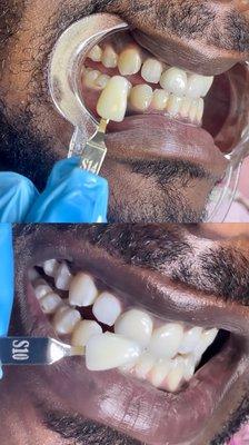 Teeth whitening, before & after.