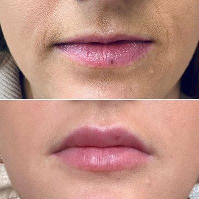 Lip Filler $550