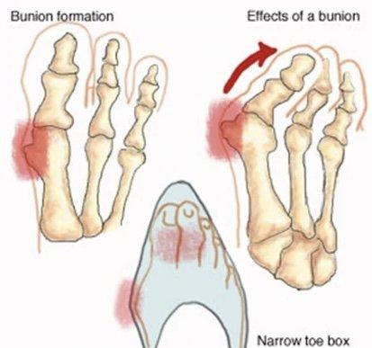 Let us help you with your bunion and foot pain.