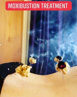 Moxibustion