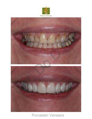 Porcelain Veneers on 10 top front teeth, linqual braces on the bottom teeth.