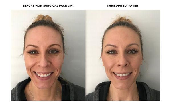 Non-Surgical Face Lift results.