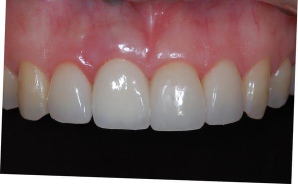 Dental Implant supported crown on upper right central incisor and porcelain veneers on adjacent teeth