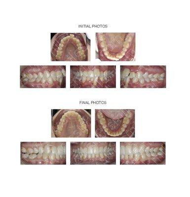 Adult treated with lower incisor extraction, enamel recontouring and Invisalign treatment for 15 months.