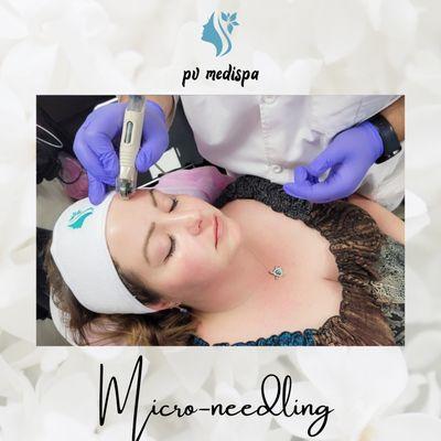 Microneedling using the DermaFrac-C system