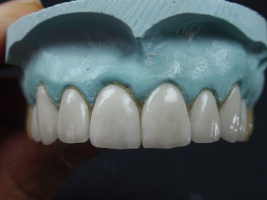 Veneers-In Lab