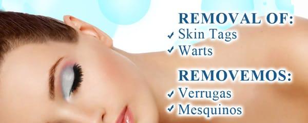 removal of skin tags and warts