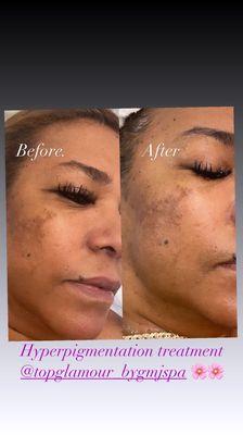 Hyperpigmentation