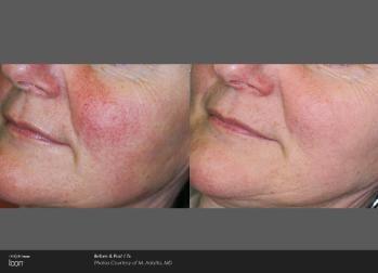 Rosacea,  excesssive redness and facial capillary removal easily treated. Very reasonable costs