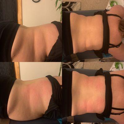 30 cavitation on back