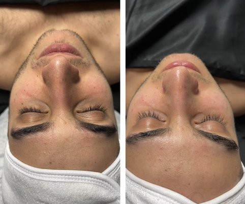 Before and After cool and express facials