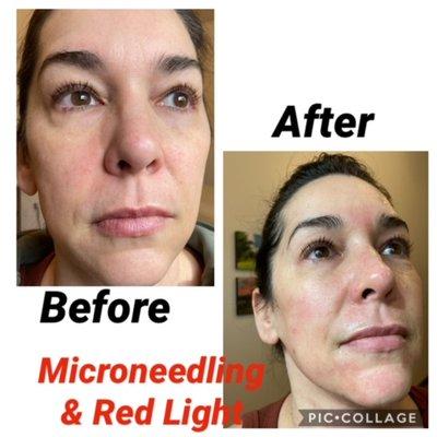 immediately after microneedling