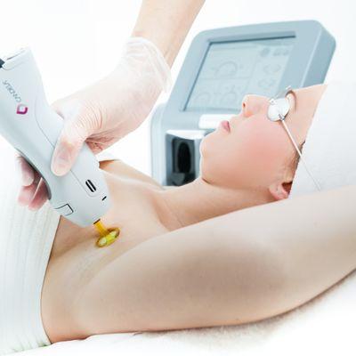 Laser Treatment of Underarms with GentleMAXPro