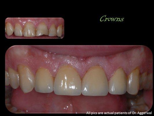 Crowns replacing broken teeth and fillings