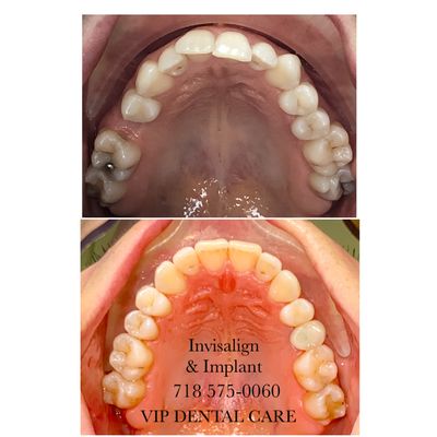 Implant and Invisalign treatment