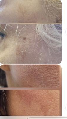 Microneedling before and after 3 treatments