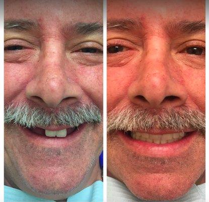 Before and After at NÜVA Smile | Bergenfield, NJ