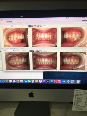 My son's transformed smile!