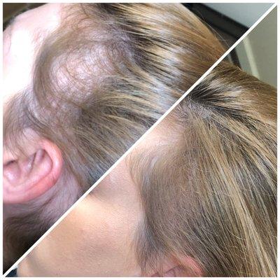 SMP for thinning hair and bald spots