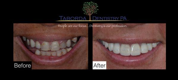 Minimally invasive cosmetic procedures with all porcelain restorations ( Metal Free)